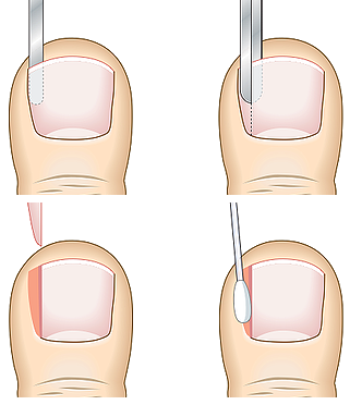 Toenail Removal Aftercare: Step-by-Step Guide for Speedy Recovery | Modern  Foot & Ankle