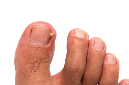 1 - Best Ingrown Toenail Surgery Cambridge | An Ingrown Toenail Is One That  Pierces The Flesh Of The Toe. It Can Feel As If You Have A Splinter, Be  Extremely Painful